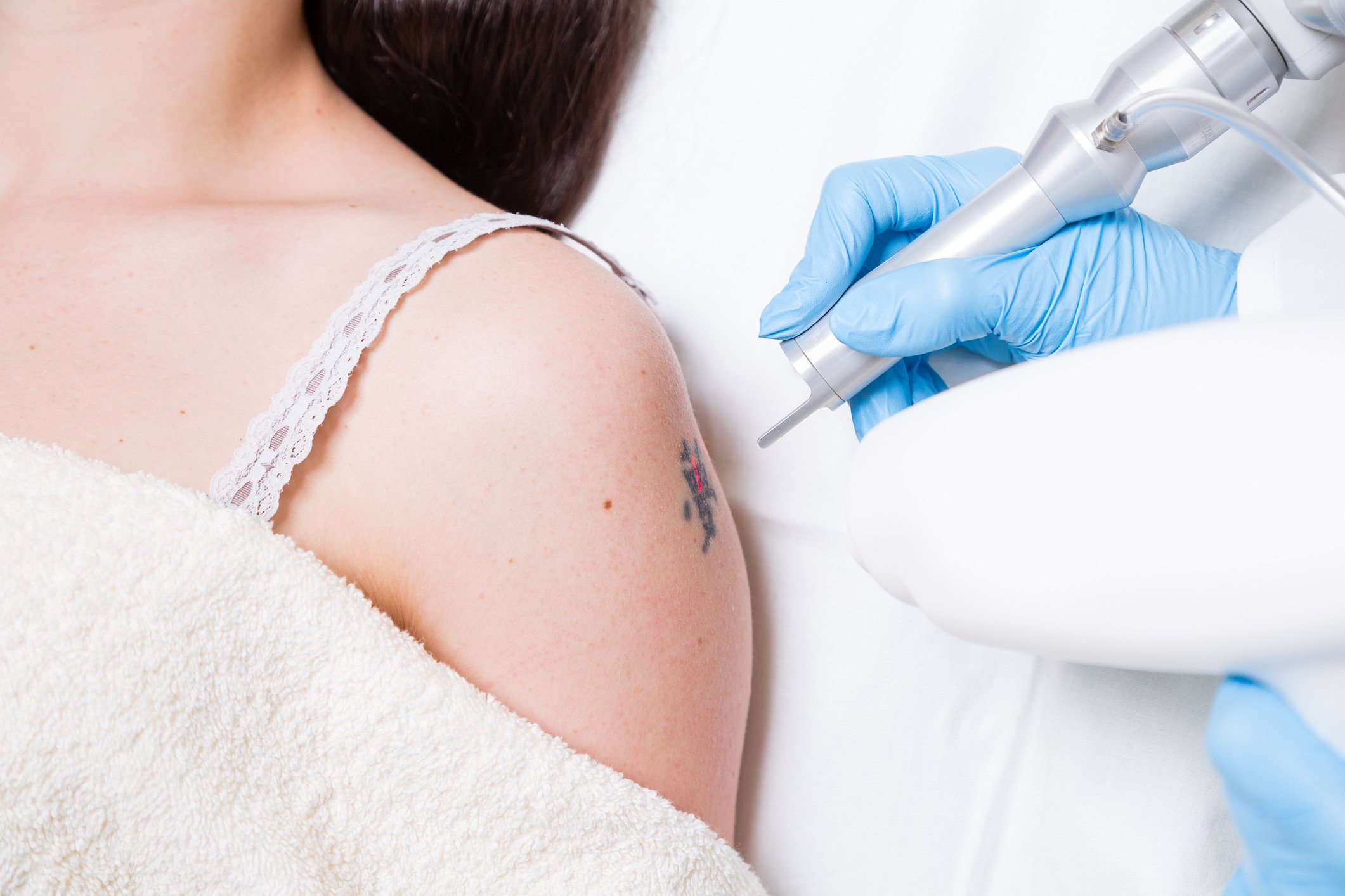 The Most Requested Questions About Laser Tattoo Elimination