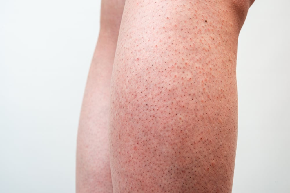 Pure Methods To Get Rid Of Strawberry Legs